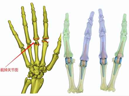 潍坊市人民医院将3D打印假体成功用于手部关节置换