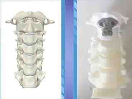 CCTV节目预告:3D打印,量身定骨!见识一下骨科医生的创新科技