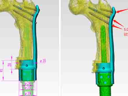 "3D打印大显神威"烟台山医院3D打印技术重塑患者新生